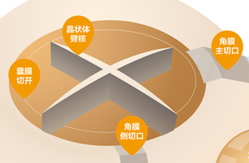 屈光性白内障手术